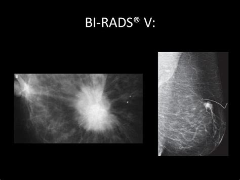 Bi Rads Ultrasound