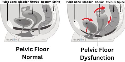 Pelvic Floor Dysfunction/Prolapse | The Backbone Osteopath Southgate