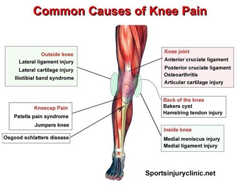 1000+ images about Health & Fitness - Sore & Aching Knees! on Pinterest | Knee Pain, Knee Pain ...