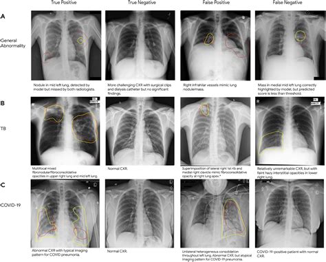 Detecting Abnormal Chest X-rays using Deep Learning – Google Research Blog