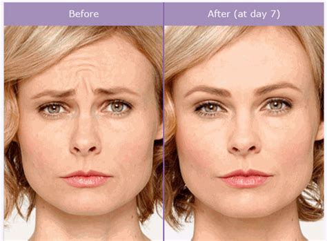 Botox San Antonio, TX | Boerne Botox