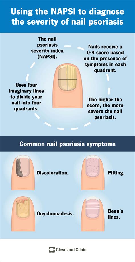 Nail Psoriasis: What It Is, Causes, Nail Pitting, Treatment