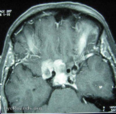 Sphenoid wing meningioma. EyeRounds.org: Online Ophthalmic Atlas