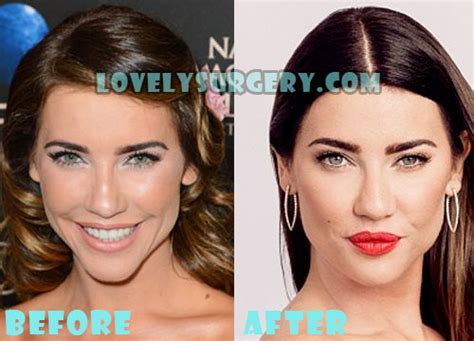 Jacqueline MacInnes Wood Plastic Surgery Before and After Photos ...