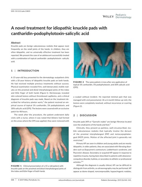 (PDF) A novel treatment for idiopathic knuckle pads with cantharidin‐podophylotoxin‐salicylic acid