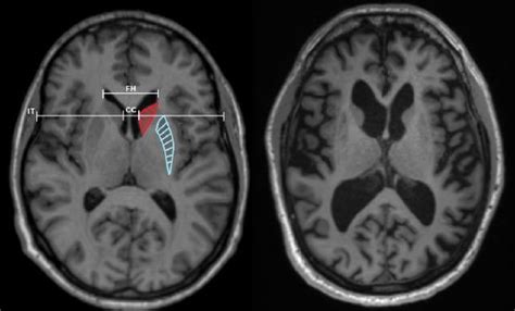 MRI brain comparison and measurements in control person and person with ...