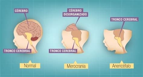 Acrania/Anencefalia – Fetalgine