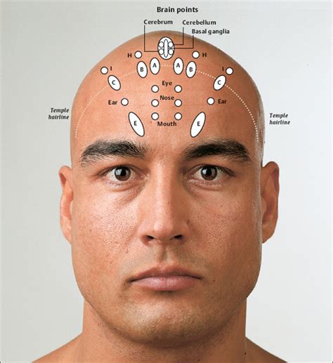 Yamamoto New Scalp Acupuncture | Musculoskeletal Key