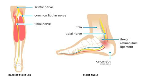 Nerve Entrapment of the Lower Extremity