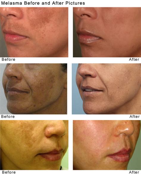 SPECTRA Laser Toning for Treating Melasma - BEAUTYWORKS