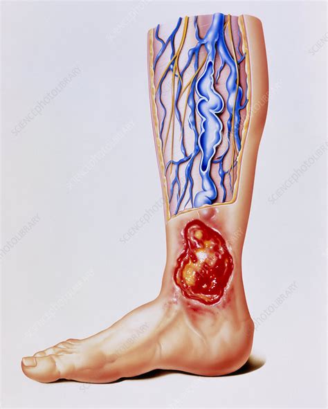 Artwork of varicose veins & ulcer on leg - Stock Image - M280/0123 - Science Photo Library