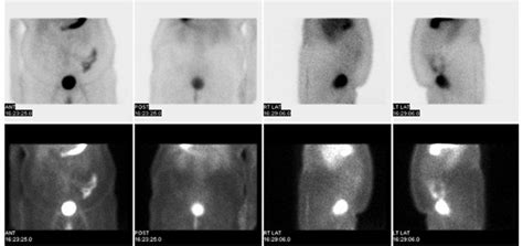 Nuclear medicine Meckel's scan: following intravenous administration of ...