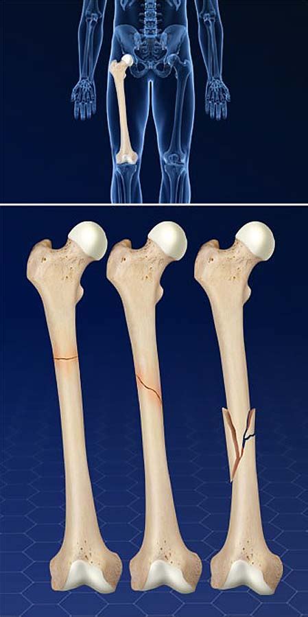 Fracturas del fémur | Grupo médico ortopédico de la costa central