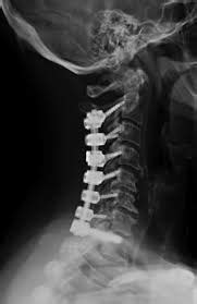 Cervical Fusion: Complications & Alternatives - CSC