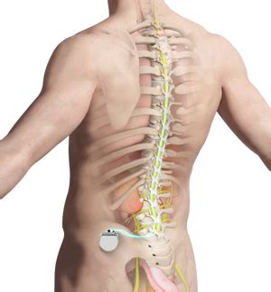 Spinal Cord Stimulator New York | Back Pain Treatment Staten Island, New York