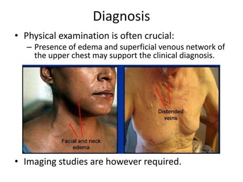 Superior vena cava syndrome | PPT