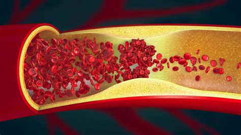 Thrombose : définition, causes, traitement et symptômes