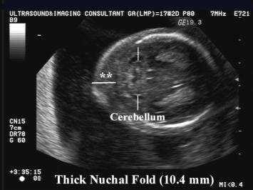 Thick Nuchal Fold