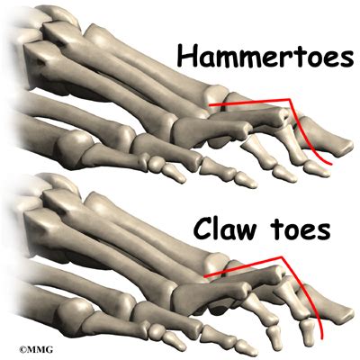 Hammer toe - eOrthopod.com