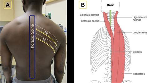 How to Perform an Erector Spinae Plane Block - ACEP Now