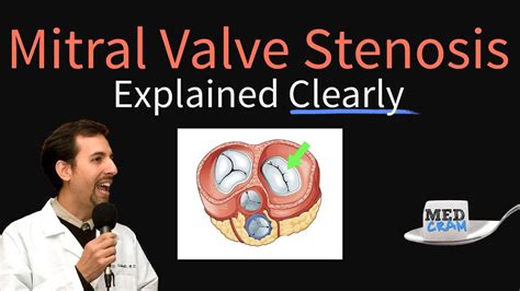 Mitral Valve Stenosis Pathophysiology