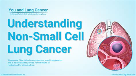 What is non-small cell lung cancer (NSCLC)?