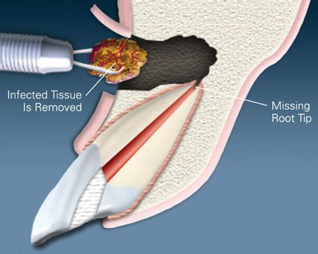 Apicoectomy Lancaster PA, Tooth Infection Reading, Gum Infection