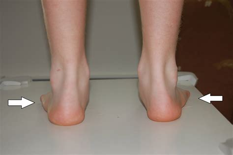 Flat Foot. Causes, symptoms, treatment Flat Foot