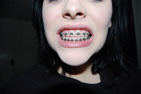 BRO's Lifestyle Guide to Adult Braces | BRO Blog