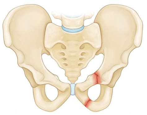 Pin on Pelvic fracture