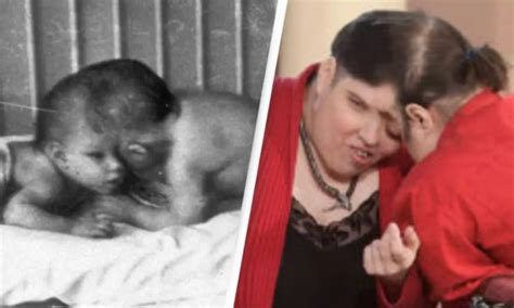 World's oldest conjoined twins George and Lori have died aged 62 ...