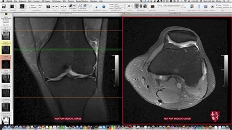 Systematic Interpretation of Knee MRI: Supplemental Cases - YouTube