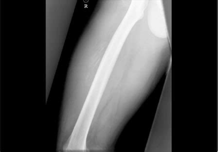 Russell's Blog: myositis ossificans histology