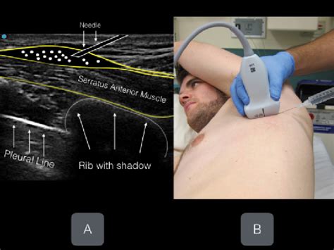 When laughter isn’t the best medicine: The serratus anterior plane ...