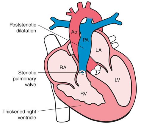 Pulmonary Atresia - Causes, Types, Symptoms, Diagnosis & Treatment