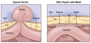 Treatment | Premier Hernia Center