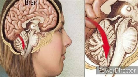 Brain Herniation or Herniation Syndrome - YouTube