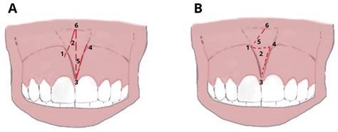 IJERPH | Free Full-Text | Laser Surgical Approach of Upper Labial Frenulum: A Systematic Review