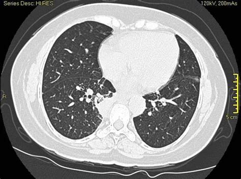 High resolution CT scan of the chest showing the lung nodules. | Download Scientific Diagram