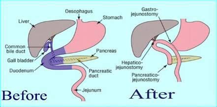 whipple | Whipple procedure, Whipple, Bile duct