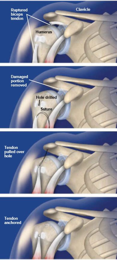 Biceps Tenodesis | Central Coast Orthopedic Medical Group