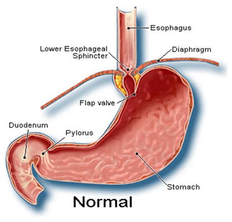 India Surgery Gastric Hiatus Hernia,Cost Gastric Hiatus Hernia Surgery