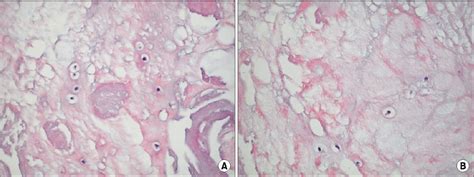 [PDF] Mucoid Degeneration of Both ACL and PCL | Semantic Scholar