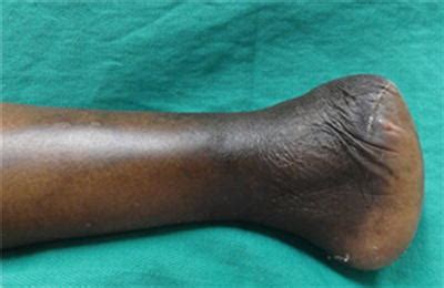 Chopart’s Amputation for Osteomyelitis of the Midfoot | Musculoskeletal Key