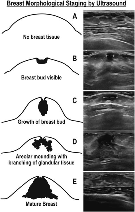 Breast Development Stages Ages