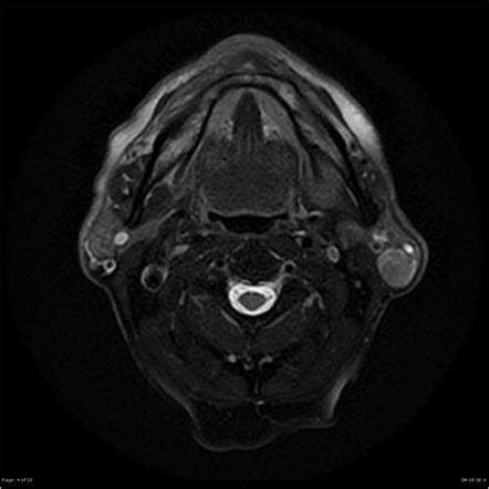 Warthin tumor | Radiology Reference Article | Radiopaedia.org