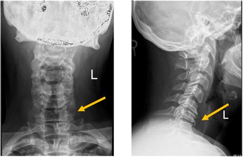 X-ray antero-posterior and lateral views of cervical spine showing ...