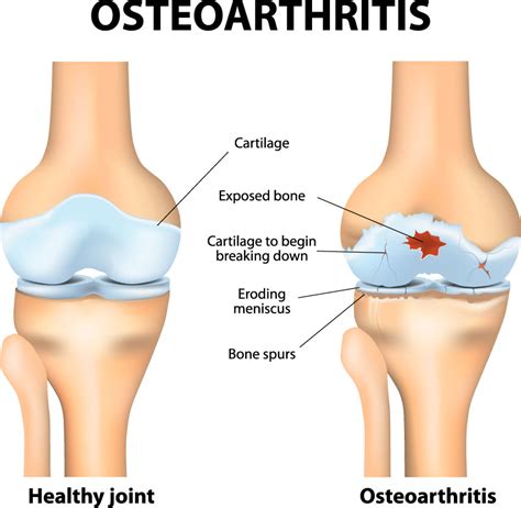 Knee Arthritis | Knee Specialist | Van Nuys, Westlake Village, Los Angeles, CA