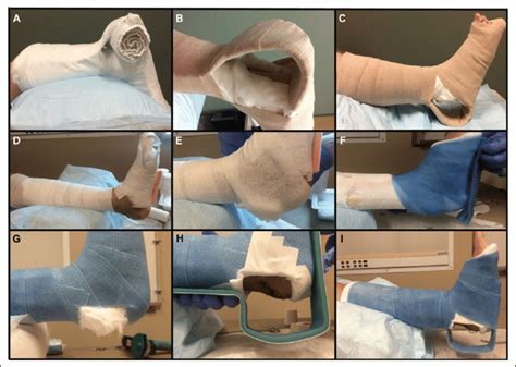 Technique for applying the modified short-leg splint/cast with ...