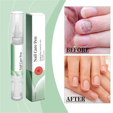 3ml Toenail Care Fungus Nail Regenerator LED Light Activated To Toenail ...